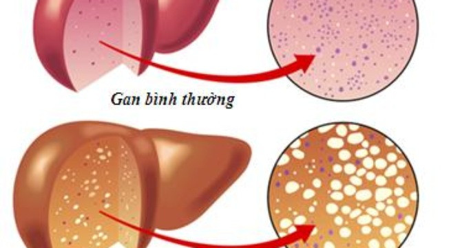 Gan nhiễm mỡ, cần phải làm gì?