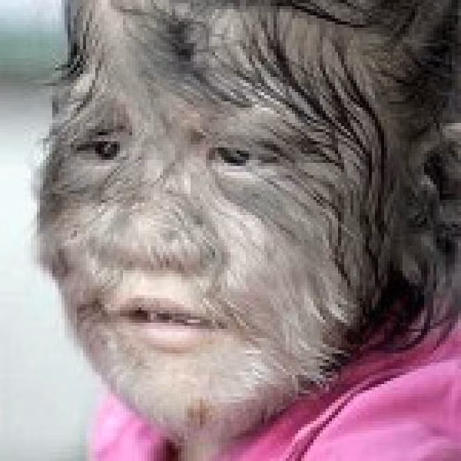 Phát hoảng với 5 căn bệnh kì lạ nhất thế giới