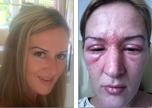 Cô Jane Rolfe, sống tại Essex (Anh) bị dị ứng khủng khiếp, da phồng rộp nặng một tuần sau khi nối mi. nối mi