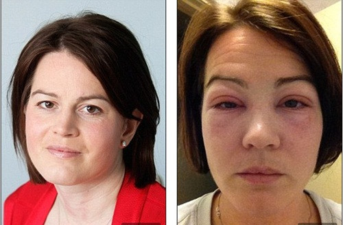 Cô Louise Jackson, từ Bexley, Kent (Anh) cũng là một trong những nạn nhân của phương pháp làm đẹp nối mi. nối mi