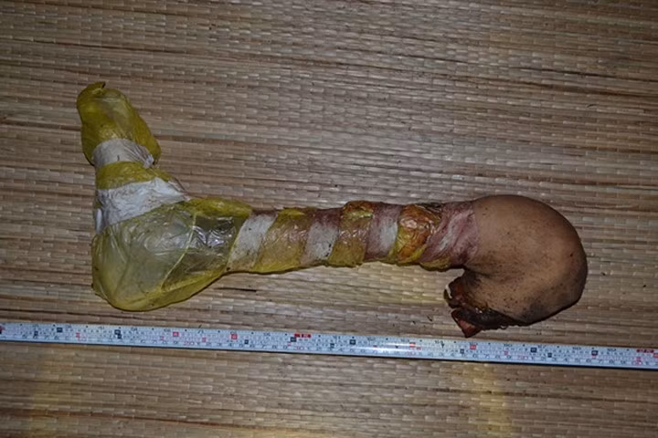 Vụ phát hiện chân người trong bãi rác: Do bệnh viện nhầm lẫn với rác thải