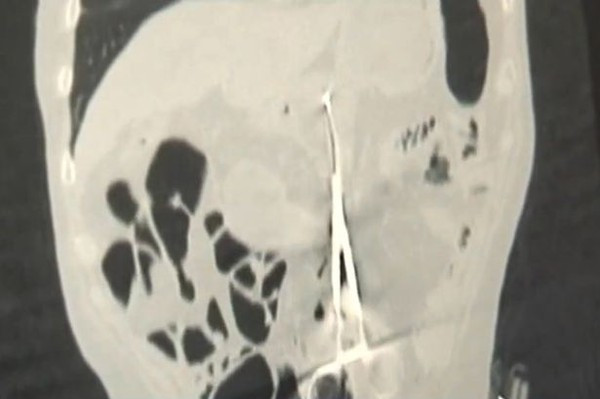 Bác sĩ bỏ quên kéo trong người nạn nhân suốt 12 năm 1