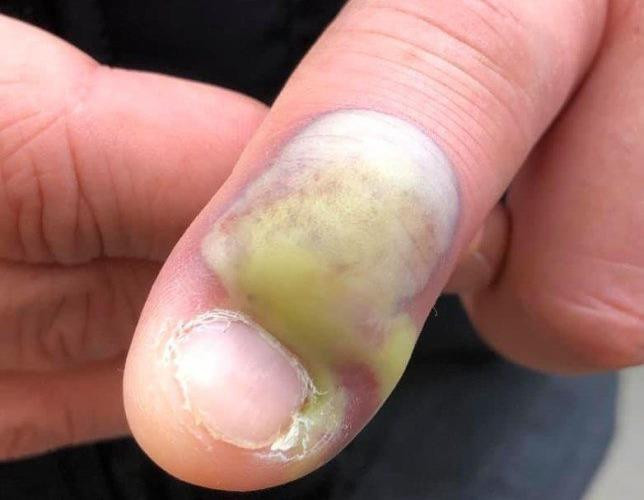 Chia sẻ về hậu quả của việc “nghiện” cắn móng tay, người phụ nữ khiến nhiều người rùng mình