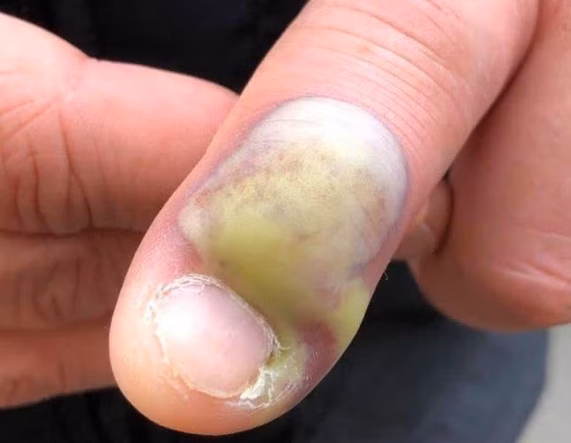 Chia sẻ về hậu quả của việc “nghiện” cắn móng tay, người phụ nữ khiến nhiều người rùng mình