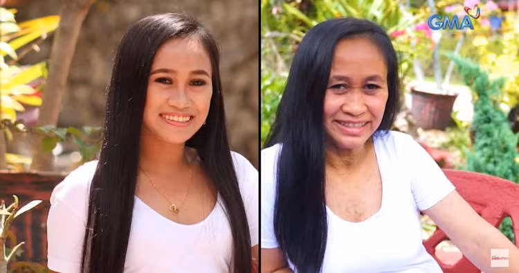 Cô gái 16 tuổi trông như bà cụ do mắc chứng bệnh hiếm gặp.