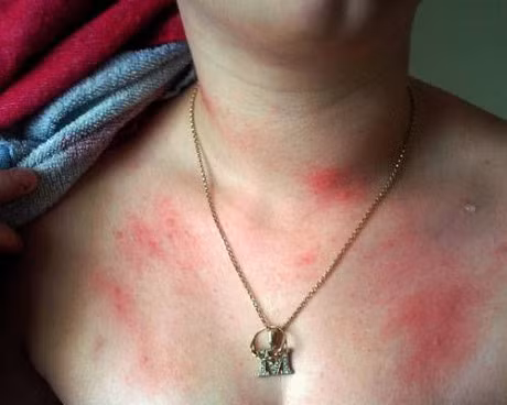 Bi kich cua nhung nguoi mac phai 5 chung di ung ky la nhat hanh tinh - Anh 2