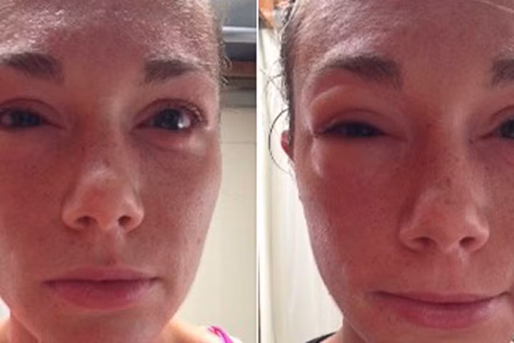 Bi kịch của những người mắc phải 5 chứng dị ứng kỳ lạ nhất hành tinh