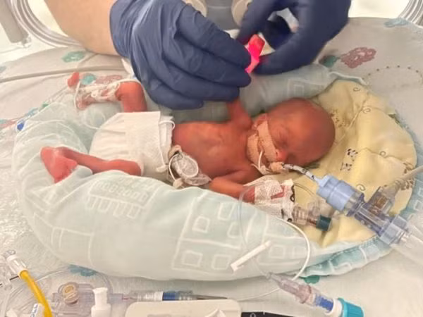 Ellie Paton sinh non bé Hannah nặng 325 gram.