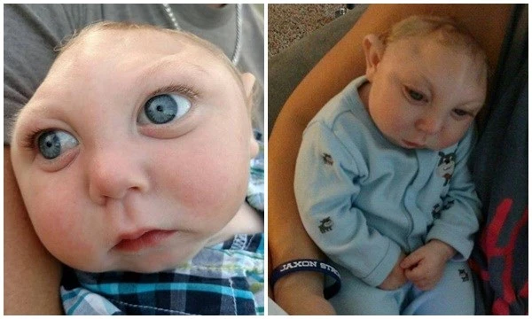 Cậu bé “não phẳng” truyền cảm hứng và nghị lực sống đến mọi người