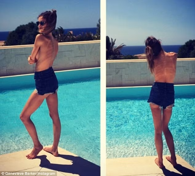 Lời kể đẫm nước mắt của cô người mẫu có thân hình như “bộ xương di động” ảnh 1