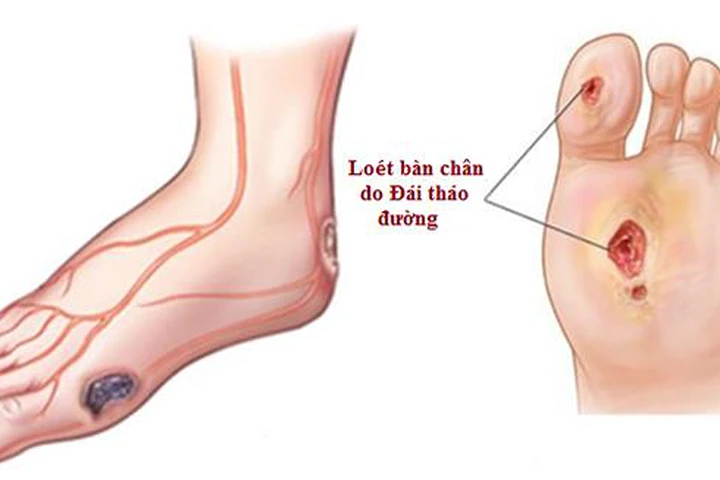 Vết loét bàn chân do đái tháo đường. Ảnh minh họa