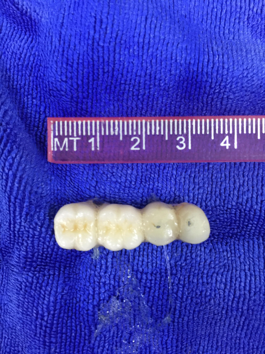 4 chiếc răng giả được bác sĩ gắp ra