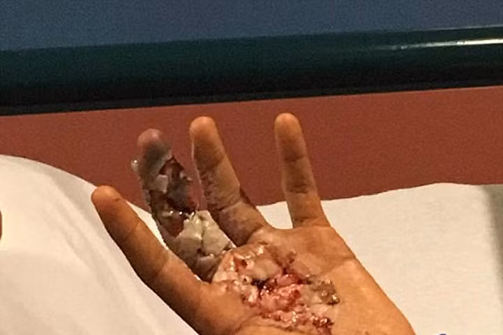 Cậu bé 13 tuổi suýt mất tay chỉ vì vết cứa do mũ bảo hiểm