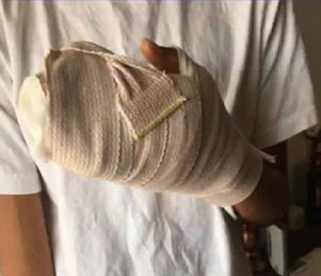 Cậu bé 13 tuổi suýt mất tay chỉ vì vết cứa do mũ bảo hiểm - Ảnh 2 Cau be 13 tuoi suyt mat tay chi vi vet cua do mu bao hiem - Anh 2