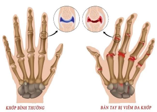 Chỉ cần sử dụng 2 lát này mỗi ngày bạn sẽ không còn bị viêm khớp và đau dạ dày