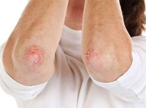 Nguyên nhân, dấu hiệu và triệu chứng của bệnh giang mai