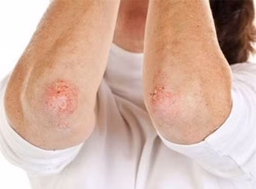 Nguyên nhân, dấu hiệu và triệu chứng của bệnh giang mai