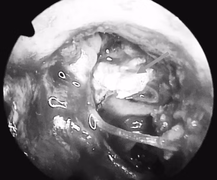 Khối Cholesteatoma ăn mòn xương con trong tai giữa.