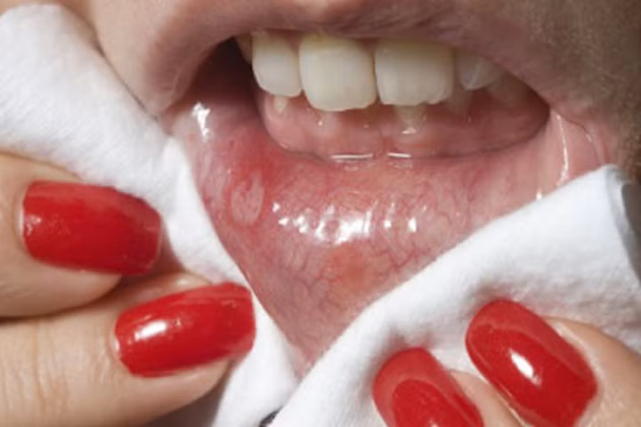 3 bài thuốc nổi tiếng trị nhiệt miệng chỉ 1 đêm đã đỡ nhiều