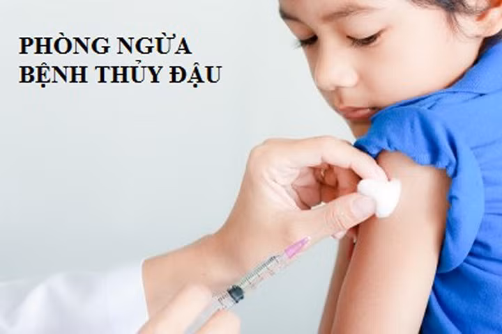 Vì sao tiêm phòng thủy đậu vẫn bị bệnh?