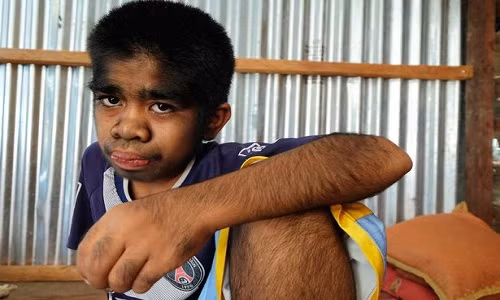 Muhammad Raihan, 13 tuổi, mắc bệnh hiếm gặp nhưng vẫn tỏ ra lạc quan