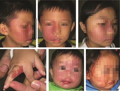 Nốt ruồi son là một dạng của u máu