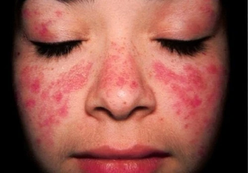 Bệnh lupus ban đỏ nguy hiểm thế nào?