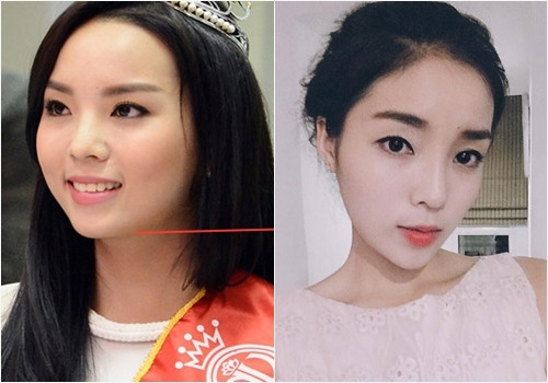 Lý do Hoa hậu Kỳ Duyên không phẫu thuật gọt mặt, độn cằm mà vẫn đẹp