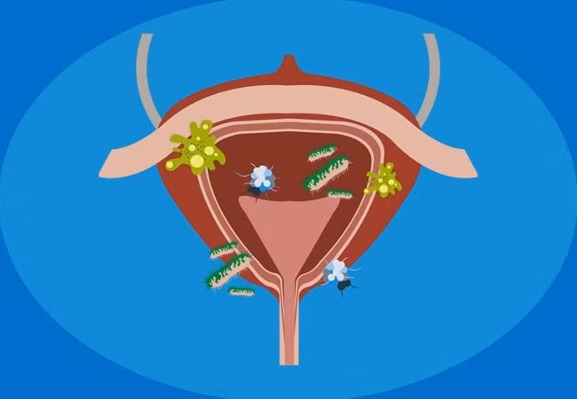 Điều gì sẽ xảy ra với cơ thể nếu nhịn tiểu quá lâu?