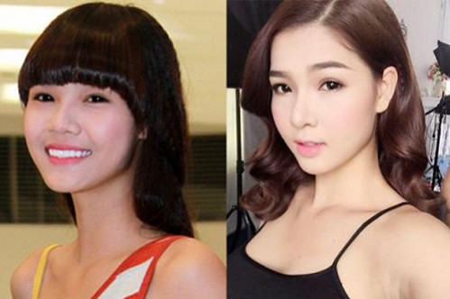 Quá trình phẫu thuật thẩm mỹ lên đời nhan sắc của Kỳ Hân 