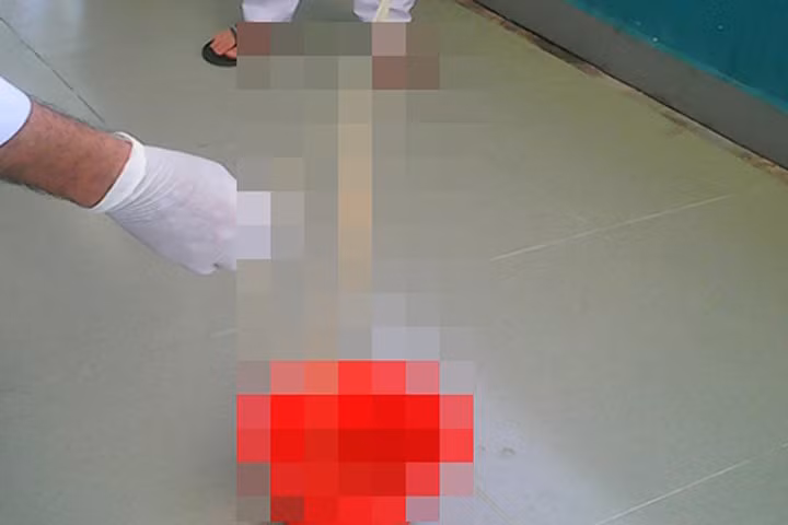 Sán xơ mít dài hơn 8 m trong bụng người đàn ông 30 tuổi