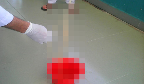 Sán xơ mít dài hơn 8 m trong bụng người đàn ông 30 tuổi - Ảnh 1 San xo mit dai hon 8 m trong bung nguoi dan ong 30 tuoi - Anh 1