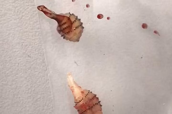 Hai con ấu còn nằm dưới da của cô gái và được bác sỹ gắp ra. (Nguồn: Daily Mail)