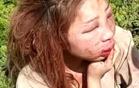 Kinh hoàng cô gái biến dạng mặt mày vì bị đánh ghen - Ảnh 2 Kinh hoang co gai bien dang mat may vi bi danh ghen - Anh 2