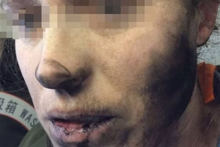 Tai nghe Bluetooth nổ trên máy bay, mặt hành khách cháy đen