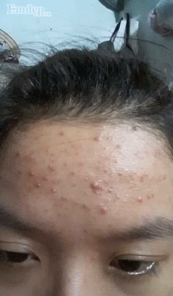 Bí kíp xóa tan mụn của cô nàng 9x chỉ trong một tháng bằng nguyên liệu nhà bếp cực hay.