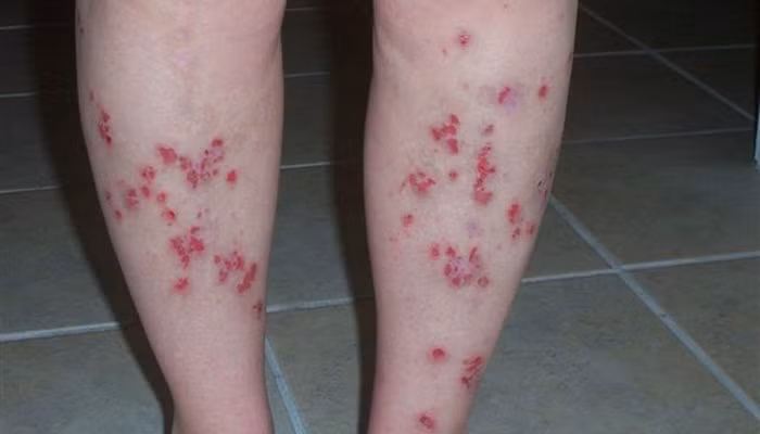 Không dám nhìn căn bệnh da liễu khủng khiếp ảnh 1