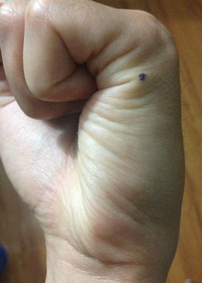 Khi rảnh rỗi nhớ day huyệt Hậu Khê, bạn sẽ thấy cận thị dần biến mất ảnh 2