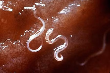 Việt Nam được công nhận loại trừ bệnh giun chỉ bạch huyết