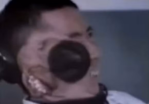 Kỳ lạ: Người đàn ông mọc thêm miệng và não trên mặt 2