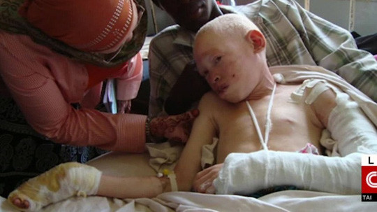 Ghê sợ nạn săn người bạch tạng ở Malawi