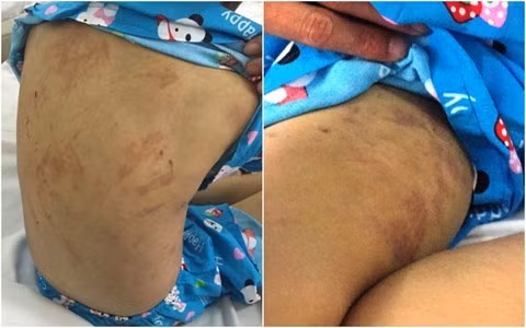 Bé A. bị đánh bầm tím cơ thể