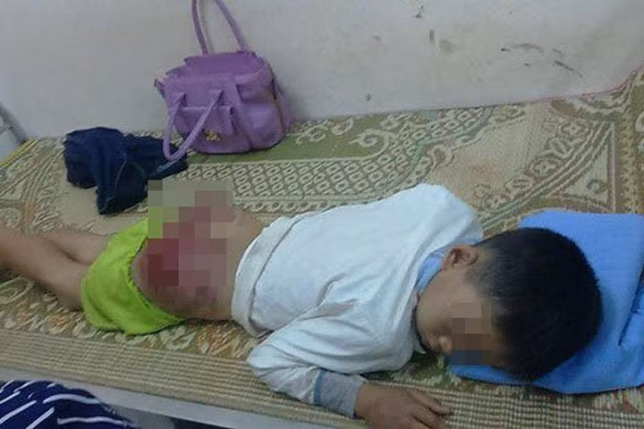 Bố đánh con nhập viện vì bỏ học nhiều ngày