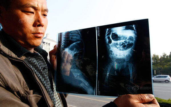 Em bé mọc kim khắp người tại Trung Quốc
