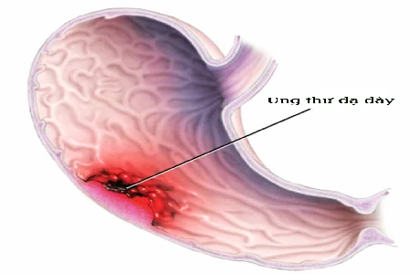 Những người dễ mắc ung thư dạ dày