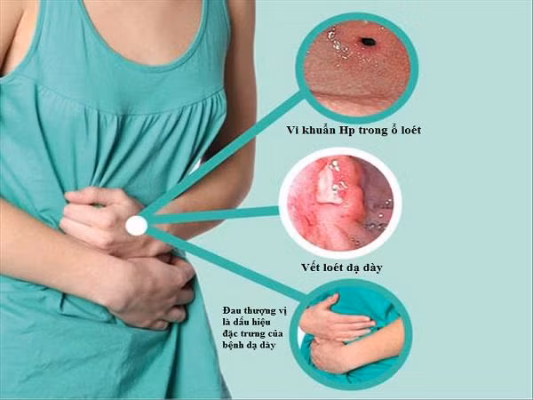 Cách chữa viêm dạ dày cực hiệu quả - Ảnh: Internet