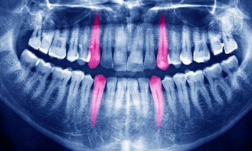 Nhiều giả thuyết được đưa ra về hiện tượng răng phát nổ trong miệng người bệnh. Ảnh: Alamy. nhung-vu-rang-tu-phat-no-bi-n-trong-lich-su-1