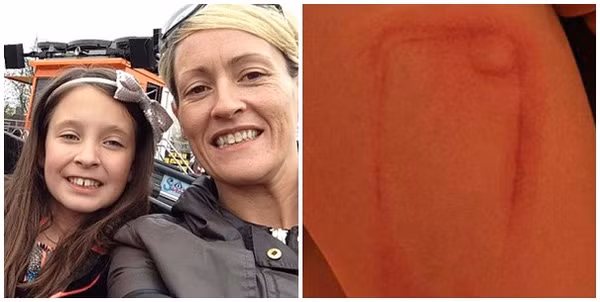 Bé gái 9 tuổi bị bỏng nặng khi đang ngủ vì dùng... ốp điện thoại iPhone