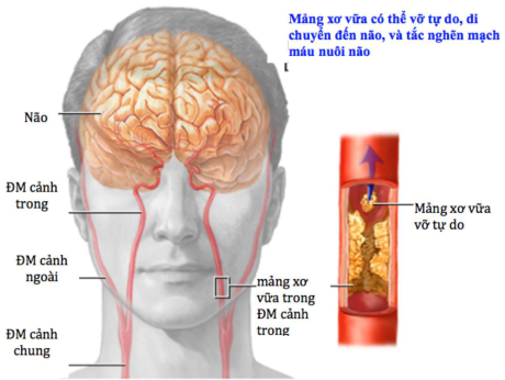 Thiếu máu não cục bộ thoáng qua và đột quỵ - Ảnh 1 Thieu mau nao cuc bo thoang qua va dot quy - Anh 1