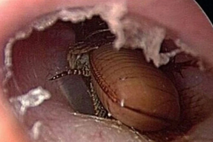 Bị gián chui vào tai, thay vì đi khám, người đàn ông lại "tự xử" bằng thuốc diệt côn trùng